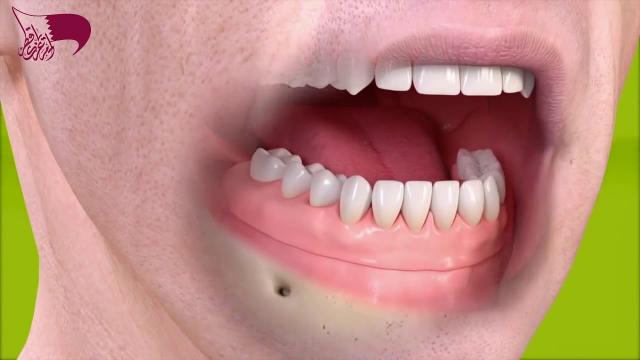 بالفيديو.. أخصائي تجميل أسنان يكشف عن كيفية زراعة فك كامل في ساعة