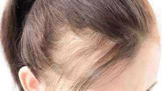 وصفة طبيعية لعلاج فراغات الشعر وزيادة كثافته