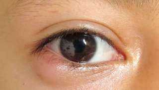 أسباب وطرق علاج الكيس الدهني في العين