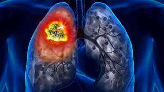 ليس التدخين وحده.. الالتهاب هو كلمة السر وراء أخطر مراحل سرطان الرئة