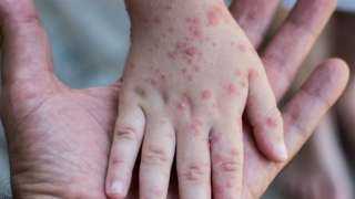 يصيب اليد والقدم والفم.. أطباء يحذرون من فيروس شديد العدوى في أمريكا