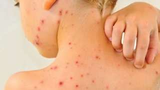 الجدري المائي عند الأطفال.. متى يظهر وكيف يمكن الوقاية منه؟
